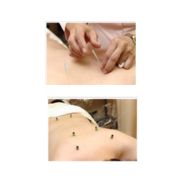 Acupuncture, Electro-Acupuncture & Moxibustion (70 Minutes) in Nagoya